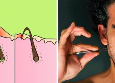 مو های زیر پوستی چرا به وجود می آیند و چطور می توان جلوی رشدشان را گرفت؟